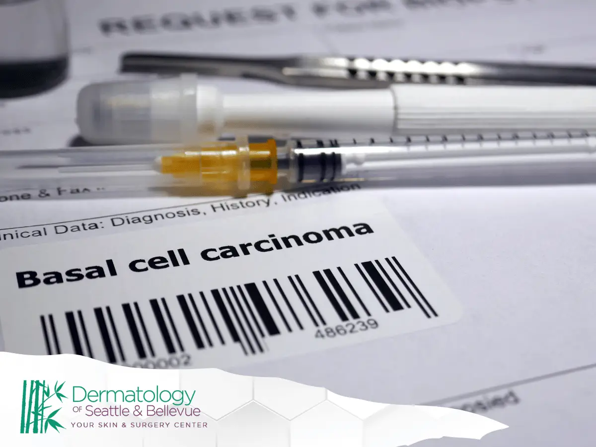 Close-up of medical documents and syringes with a label indicating 'Basal cell carcinoma,' highlighting dermatological diagnosis.