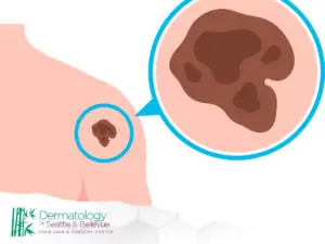 Illustration of a skin mole on a shoulder, zoomed in to show detail, representing dermatological care provided by Dermatology of Seattle & Bellevue.