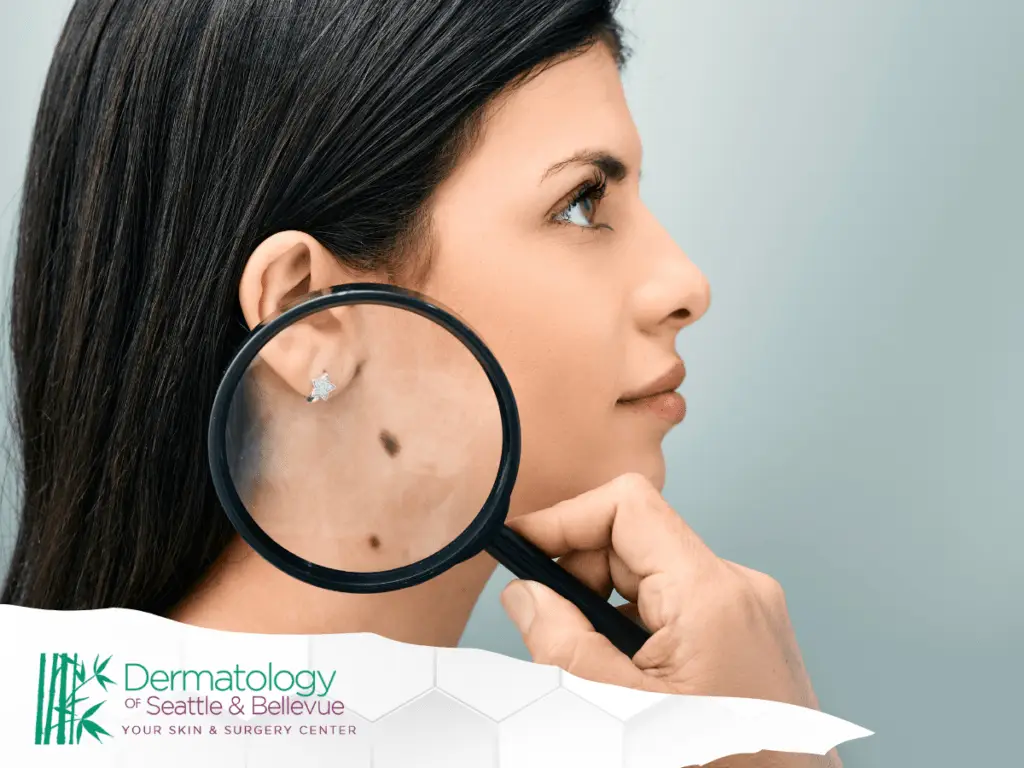 Side profile of a woman with a magnifying glass highlighting moles on her skin, emphasizing skin examination and dermatological care.