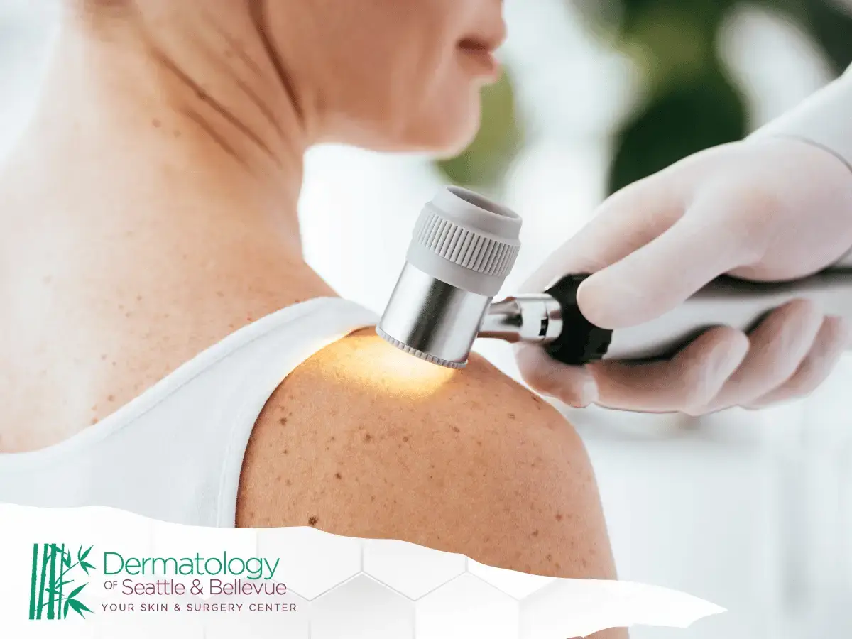 Dermatologist using a dermatoscope to examine a patient's shoulder for skin evaluation.