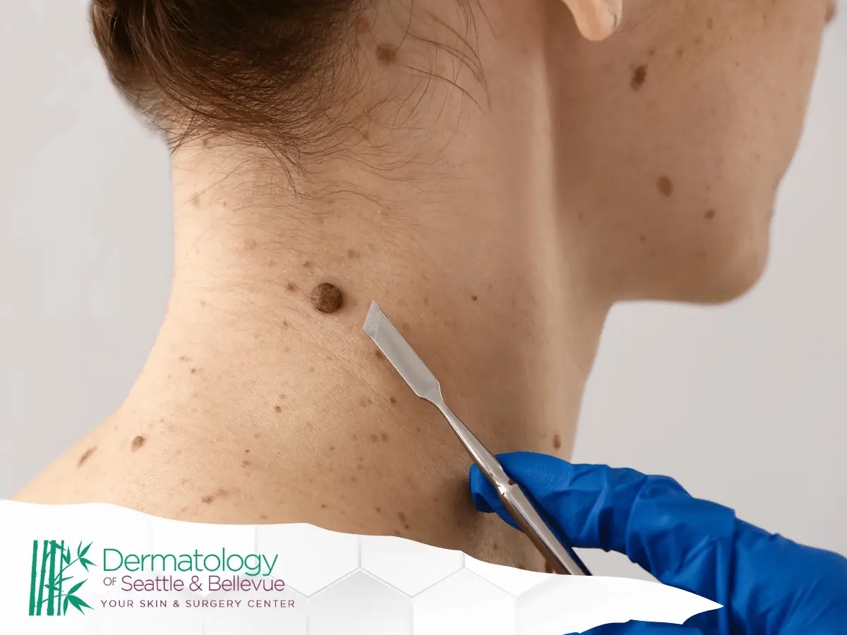 Close-up of a medical professional using a scalpel to examine a mole on a patient's neck, highlighting dermatological procedures.