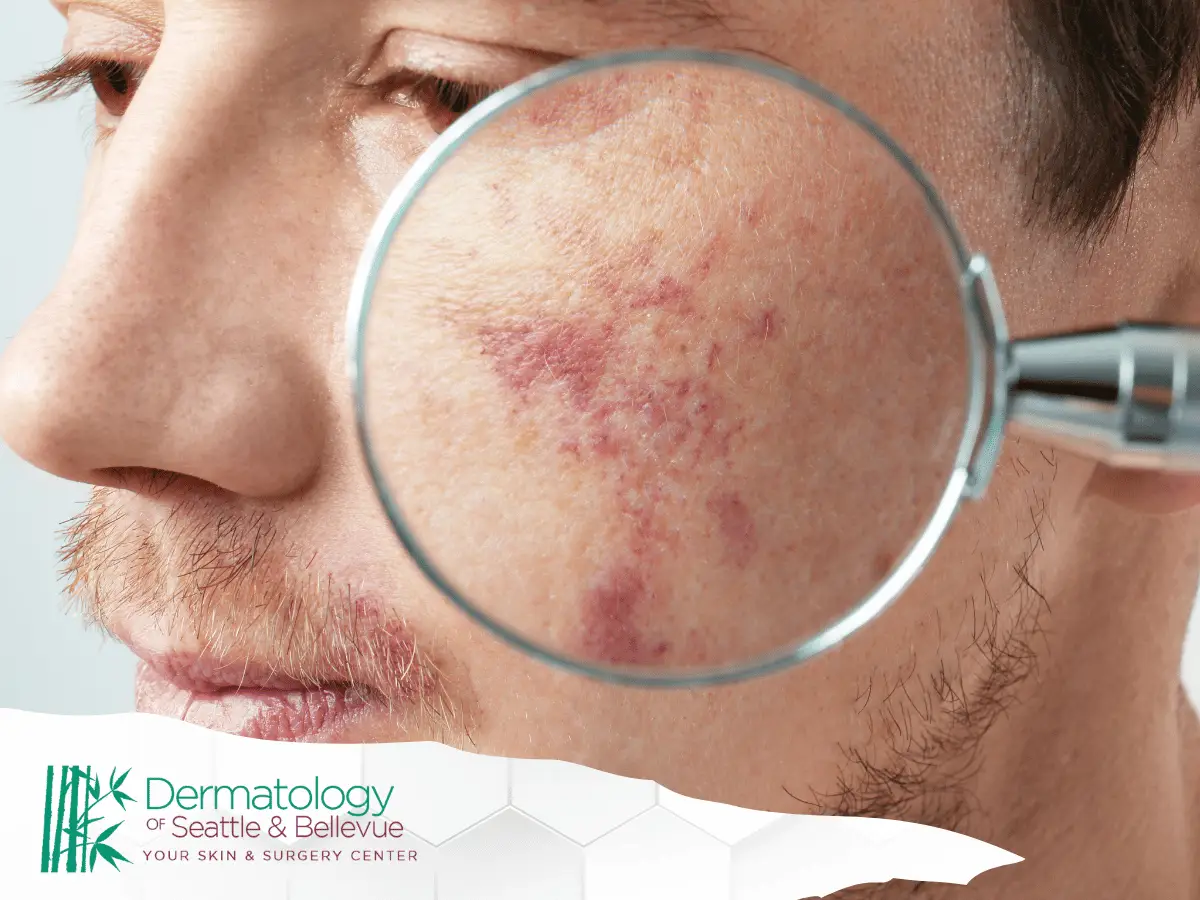 Close-up of a magnifying glass highlighting skin redness and irritation on a man's cheek.