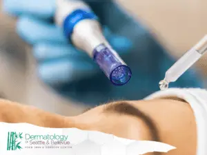 A close-up view of a skin treatment procedure with a microneedling pen and a dropper applying serum on the skin, performed at Dermatology of Seattle & Bellevue.