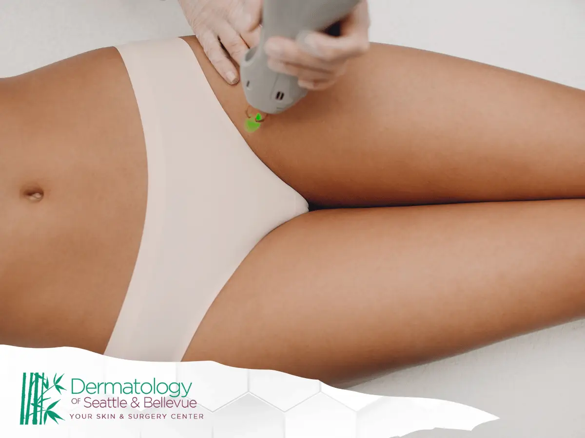 Close-up of bikini line laser hair removal treatment in progress.