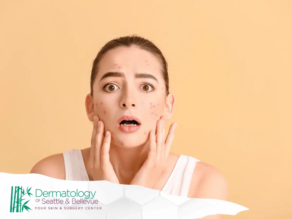 Young woman with facial acne touching cheeks, looking worried.