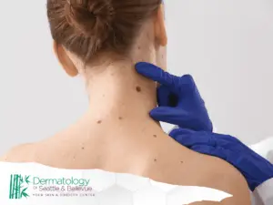Dermatologist examining a large mole on a woman’s neck