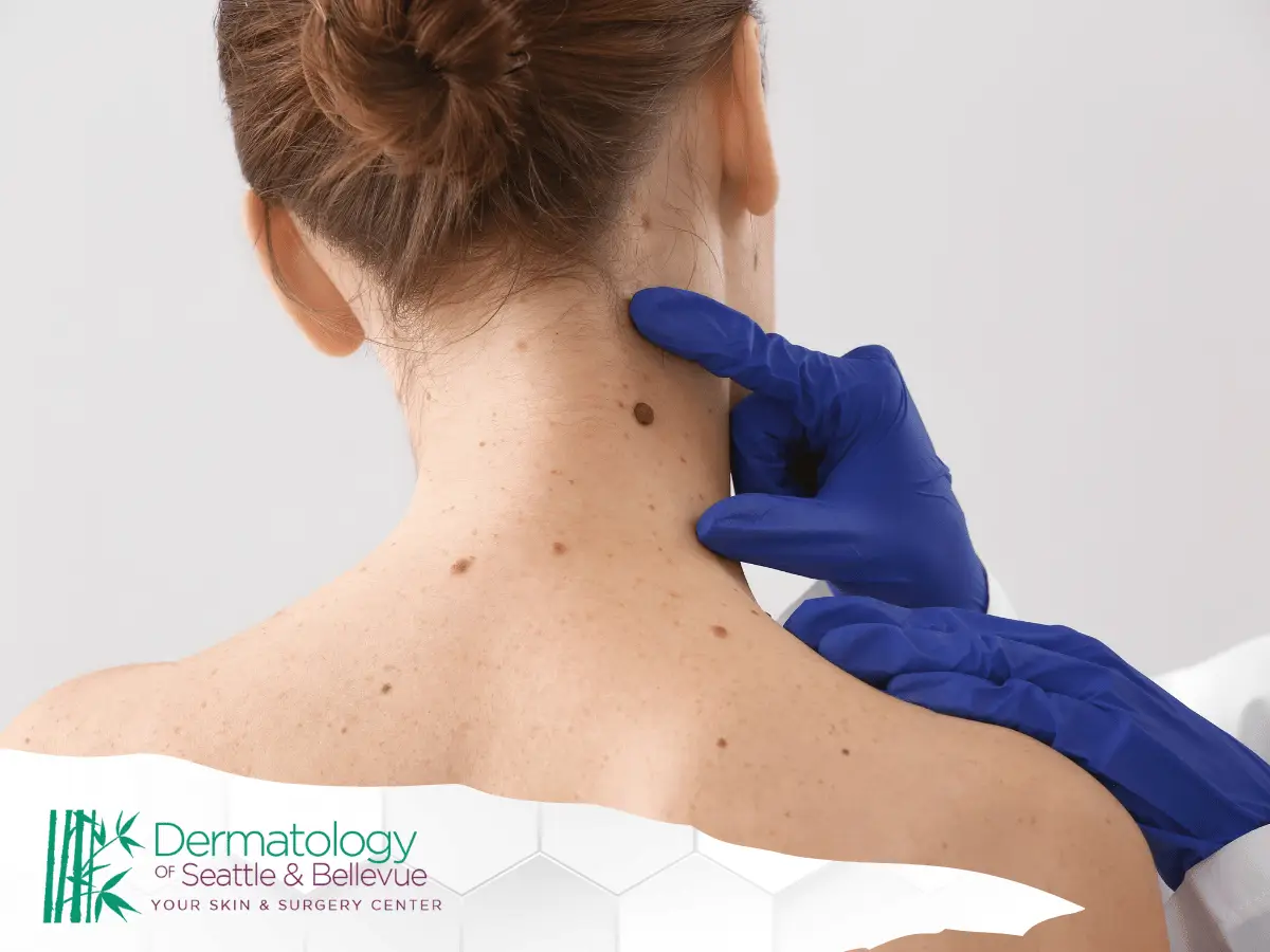 Dermatologist examining a large mole on a woman’s neck