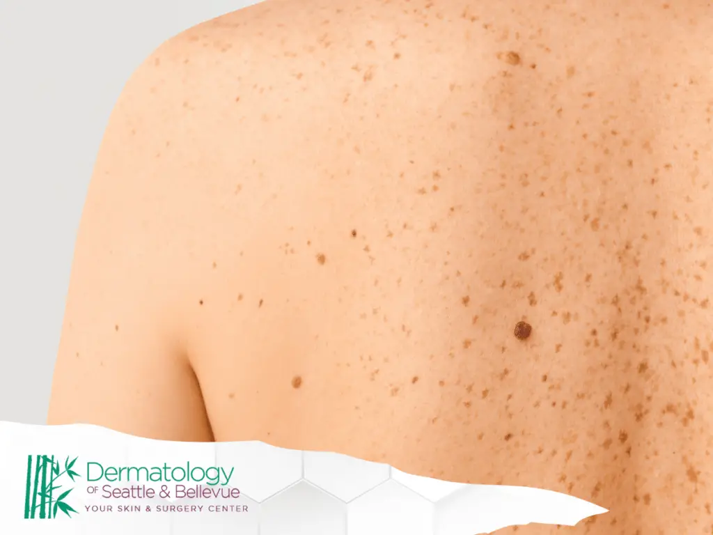 Close-up of a freckled back with several small moles.