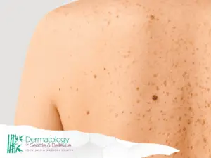 Close-up of a freckled back with several small moles.