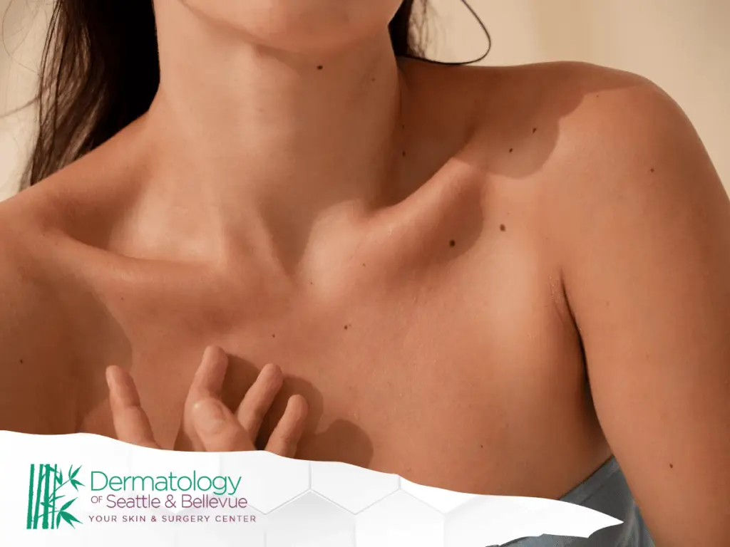 Close-up of woman’s bare upper chest with scattered moles.