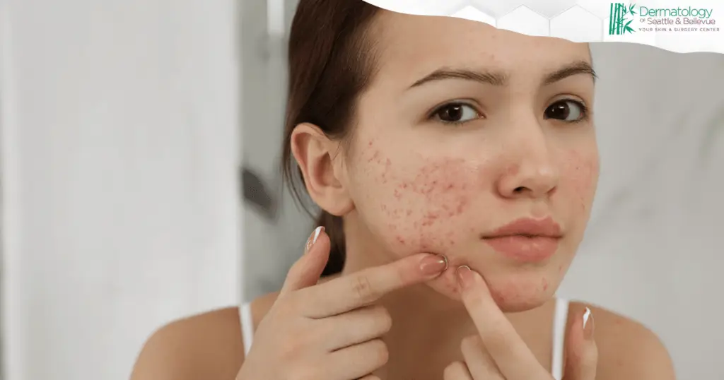 Young woman examining acne on her cheek in bathroom mirror.