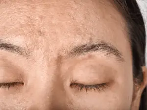 Close-up of person’s forehead with acne, textured skin, closed eyes.