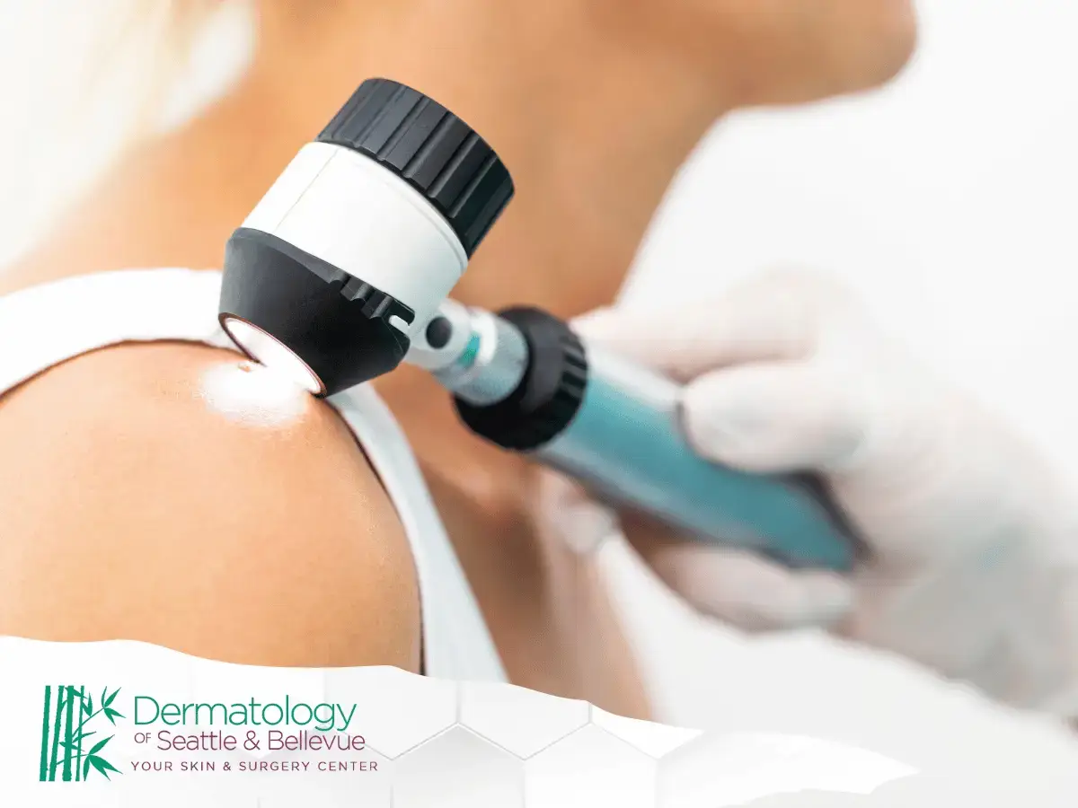 Gloved hand using dermatoscope to examine mole on shoulder