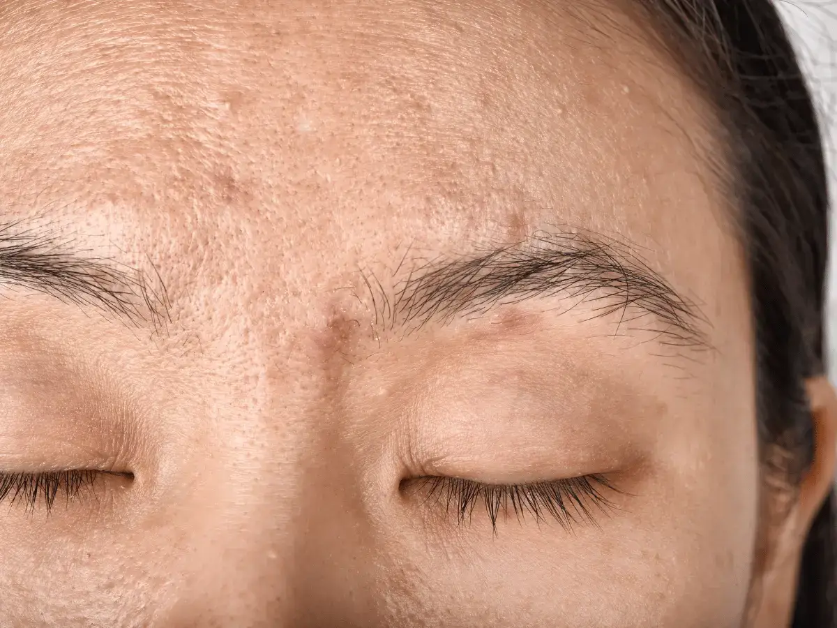 Close-up of person’s forehead with acne, textured skin, closed eyes.