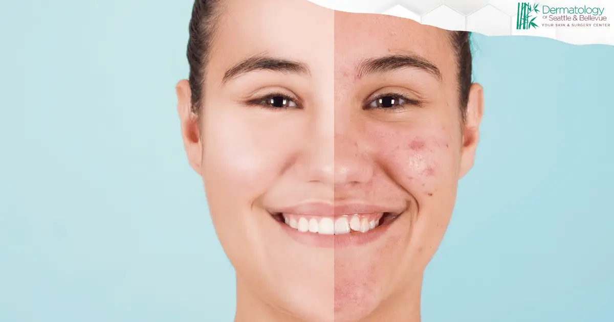 Split-face portrait showing clear skin on left, acne on right.