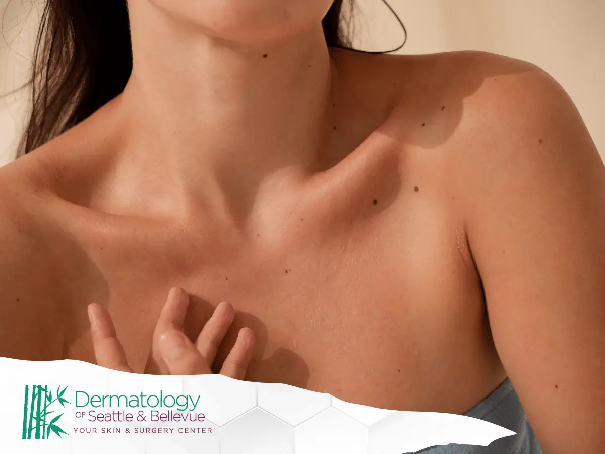 Close-up of woman’s bare upper chest with scattered moles.