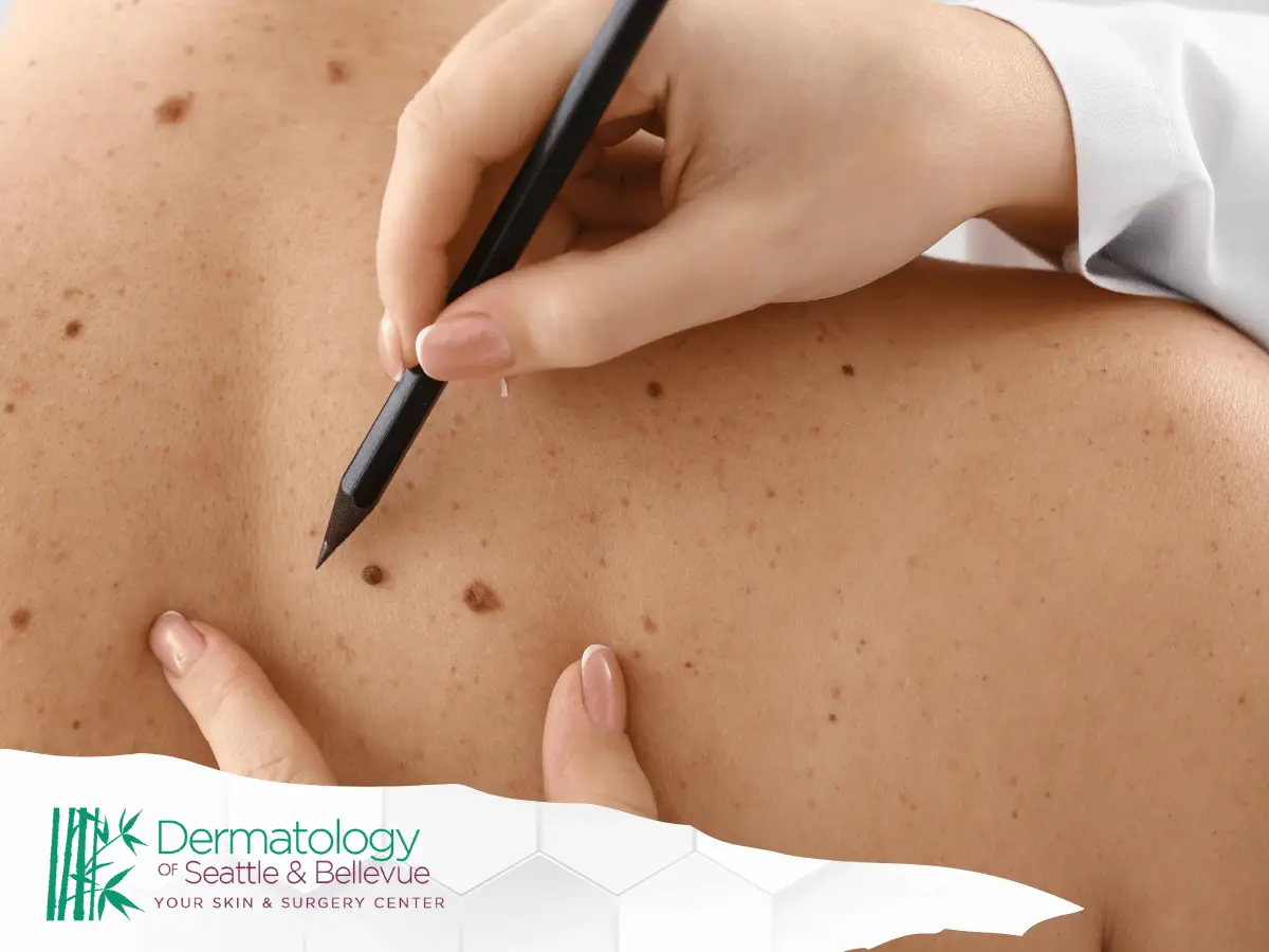 Doctor examining moles on patient’s back with black pencil.