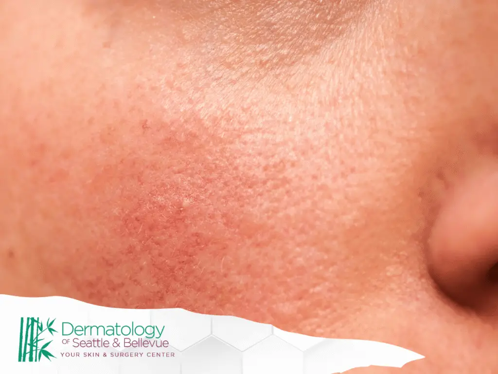 Close-up of a cheek with redness, bumps, and visible pores.