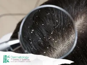 Magnified view of scalp with dark hair and visible white flakes.