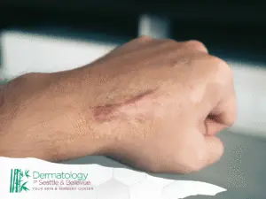 Close-up of a hand showing a raised scar on knuckles.