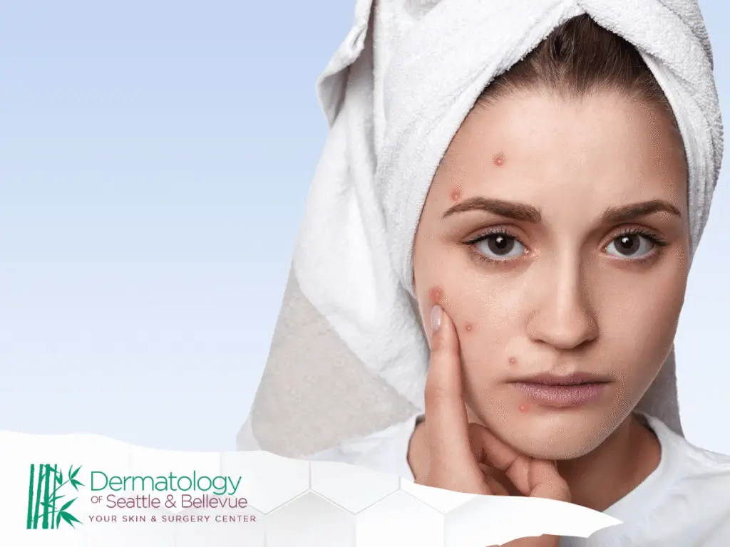 Woman with towel on head touching acne on her face