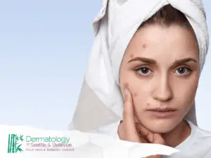 Woman with towel on head touching acne on her face