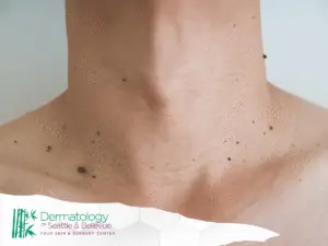 Close-up of a person’s neck with multiple small moles