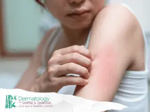 Person scratching red, irritated skin on upper arm.