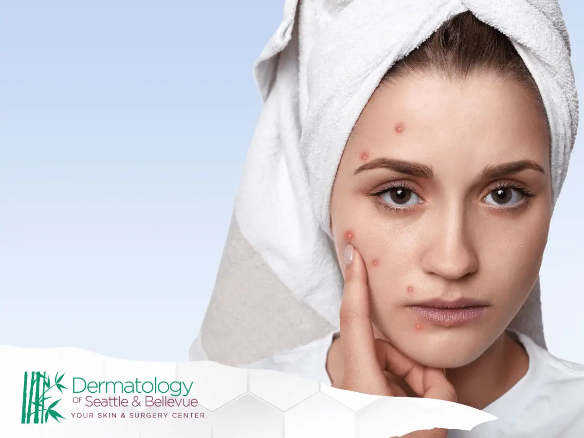 Woman with towel on head touching acne on her face