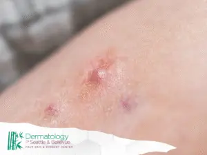 Close-up of inflamed red skin bumps on a person’s body.