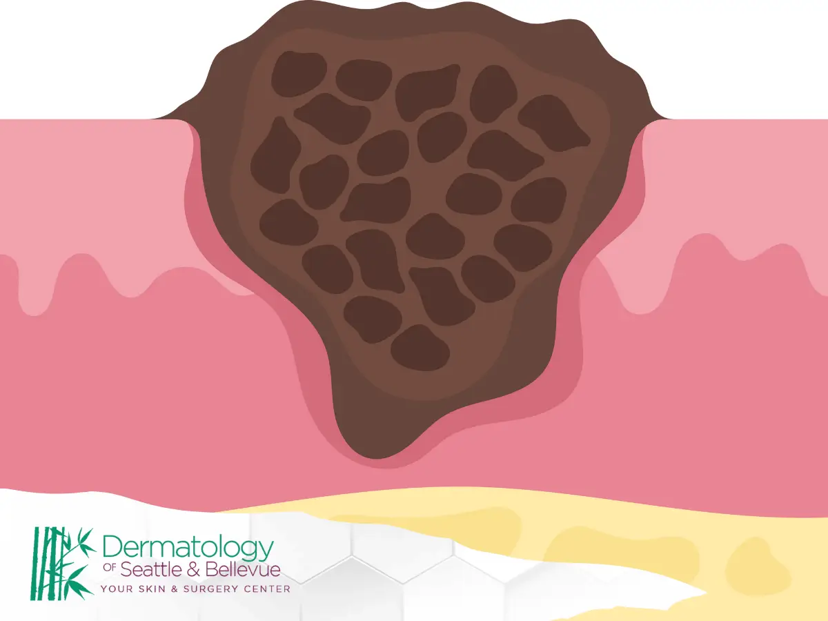 Illustration of raised, dark, textured skin lesion on pink skin