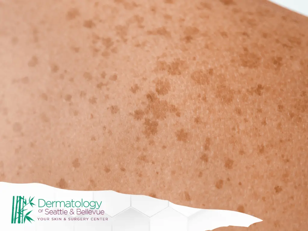 Close-up of freckled light-brown skin with scattered dark spots.