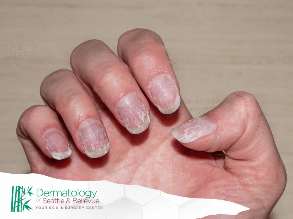 Close-up of hand with peeling, damaged fingernails on light background.