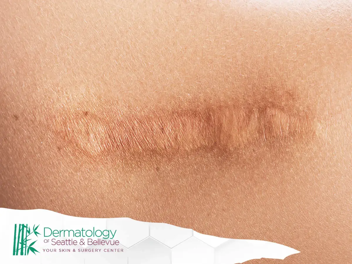 Close-up of a raised, linear scar on light brown skin.