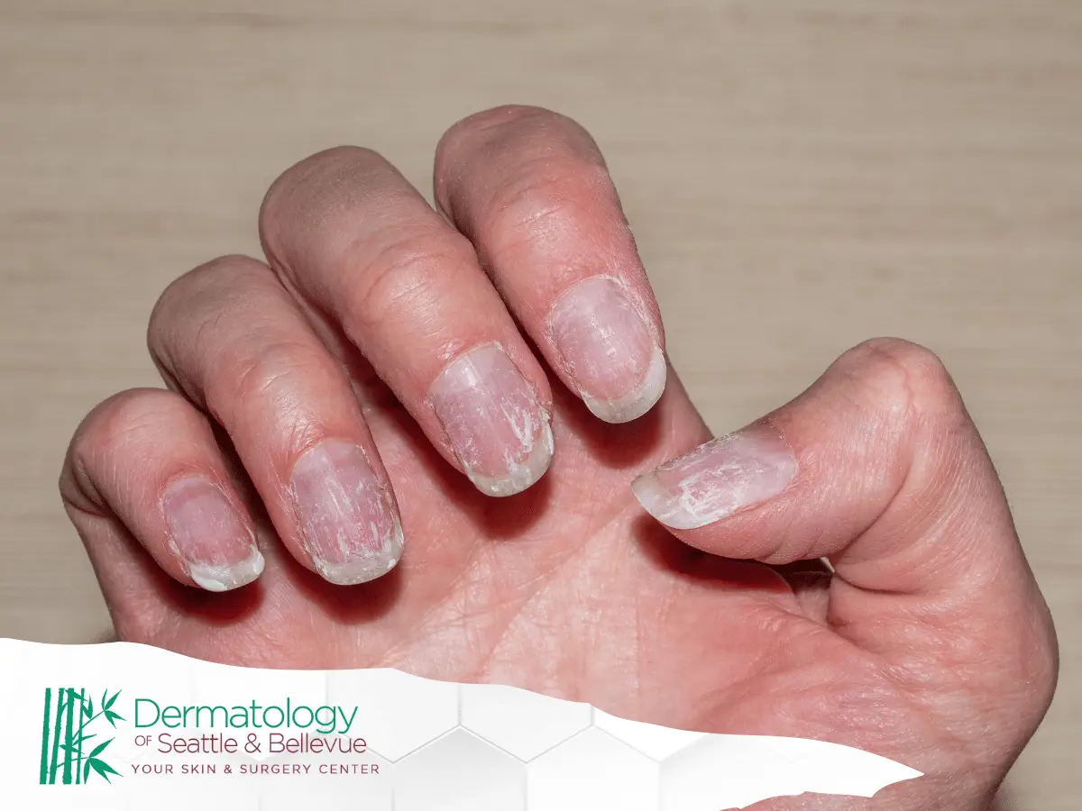 Close-up of hand with peeling, damaged fingernails on light background.
