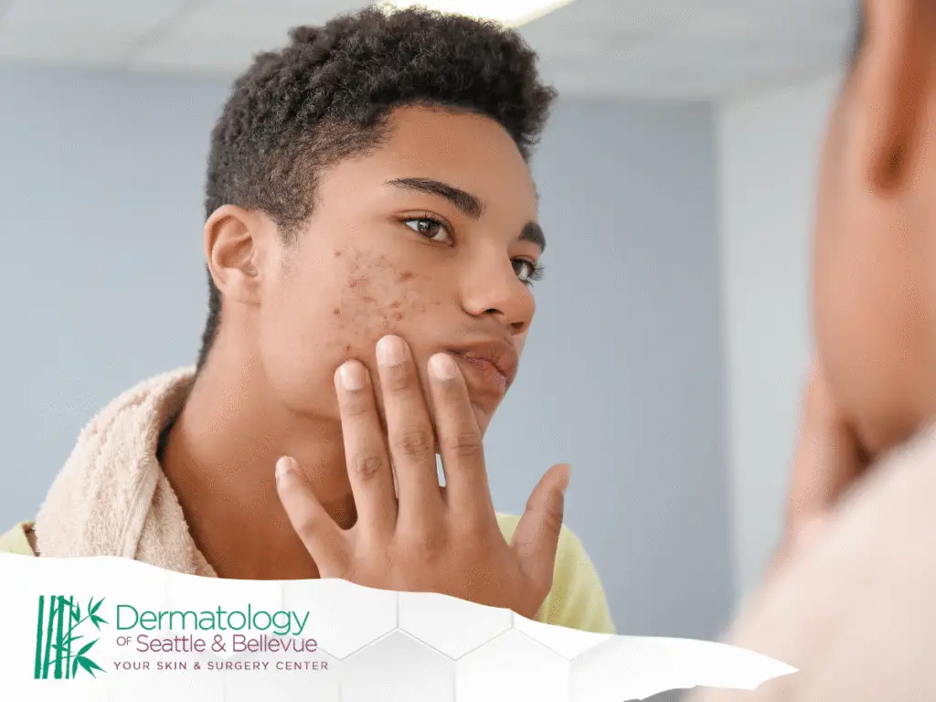 Teen boy examining acne on his cheek in bathroom mirror