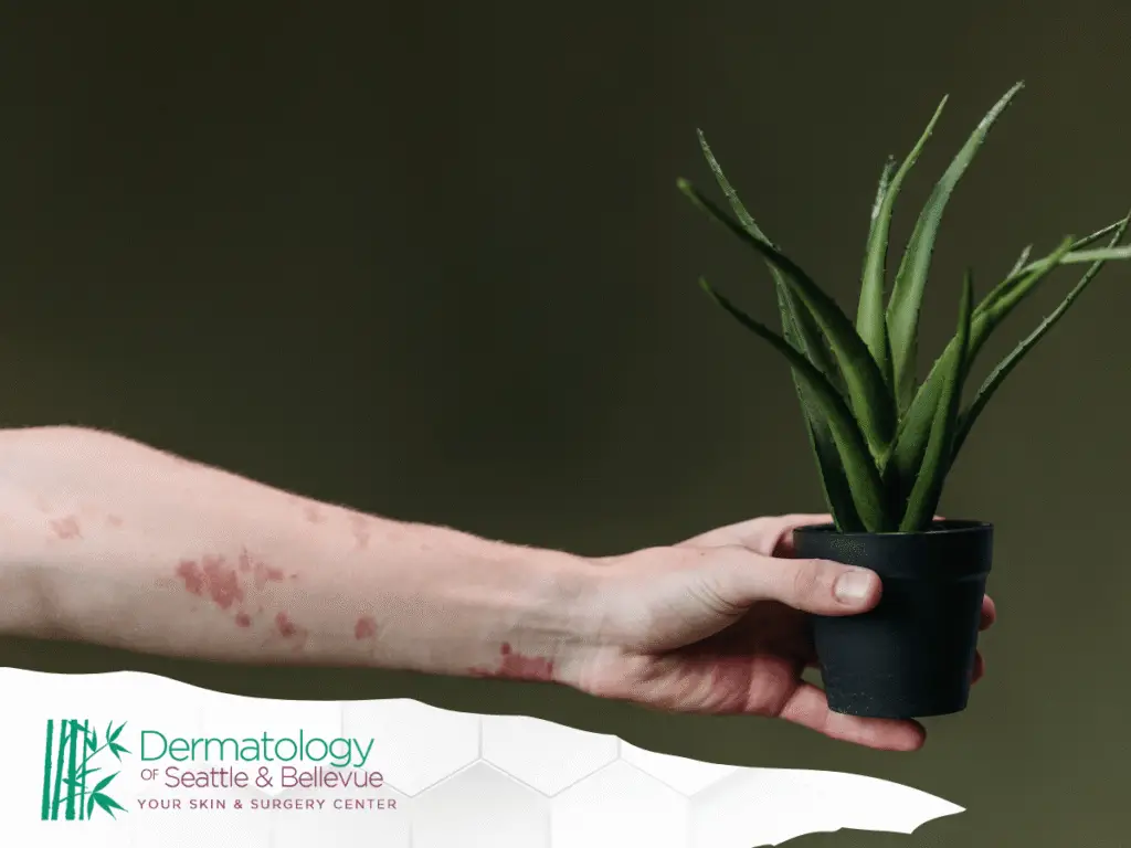 Arm with red skin rash holding small potted aloe plant