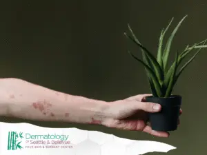 Arm with red skin rash holding small potted aloe plant