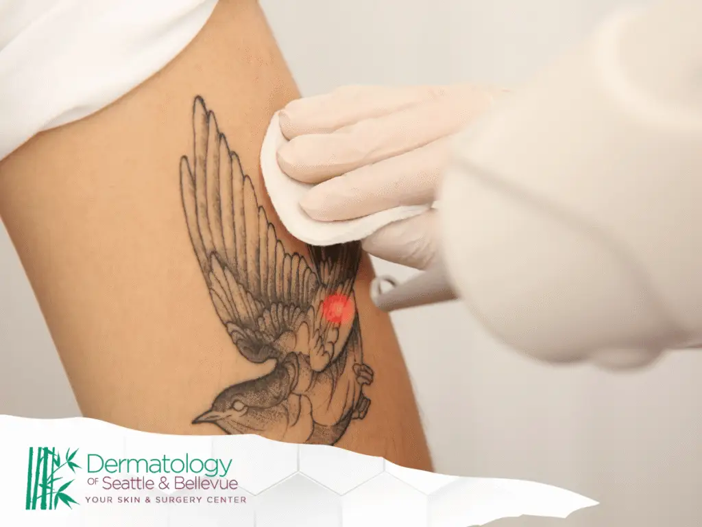 Gloved hands using laser device to remove bird tattoo on skin