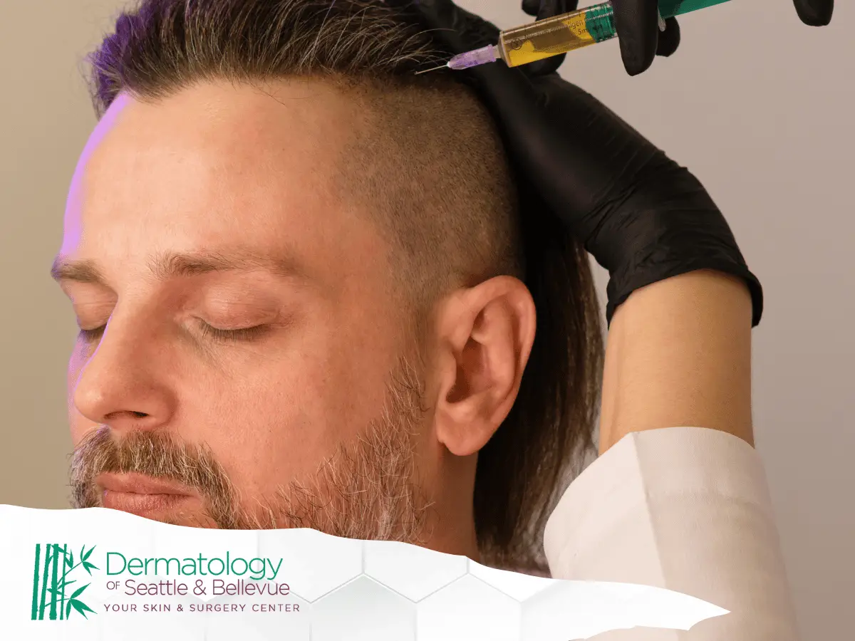 prp treatment dermatology of seattle