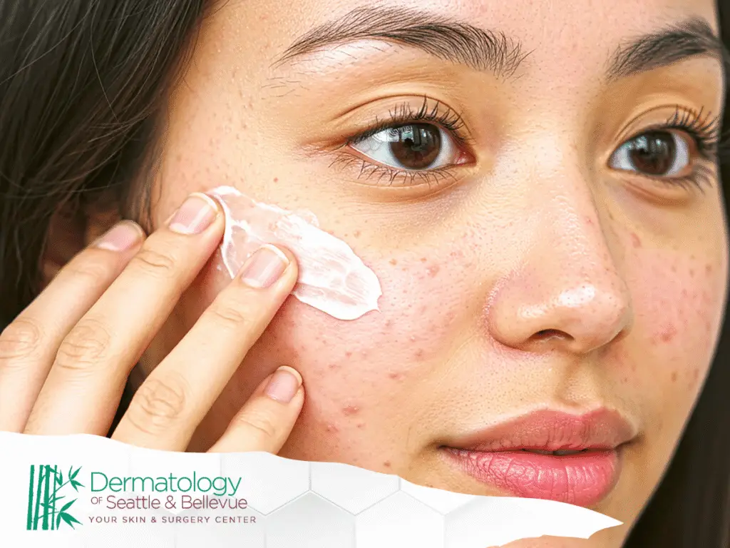 Young woman applying cream to acne-prone skin on cheek.