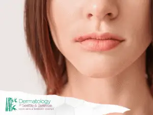 Close-up of woman’s lips with redness and dry cracked skin.