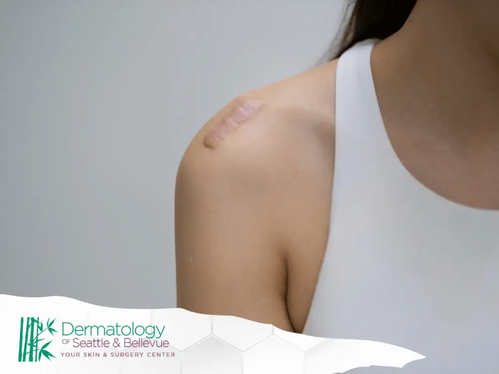 Close-up of woman’s shoulder showing raised pink scar.