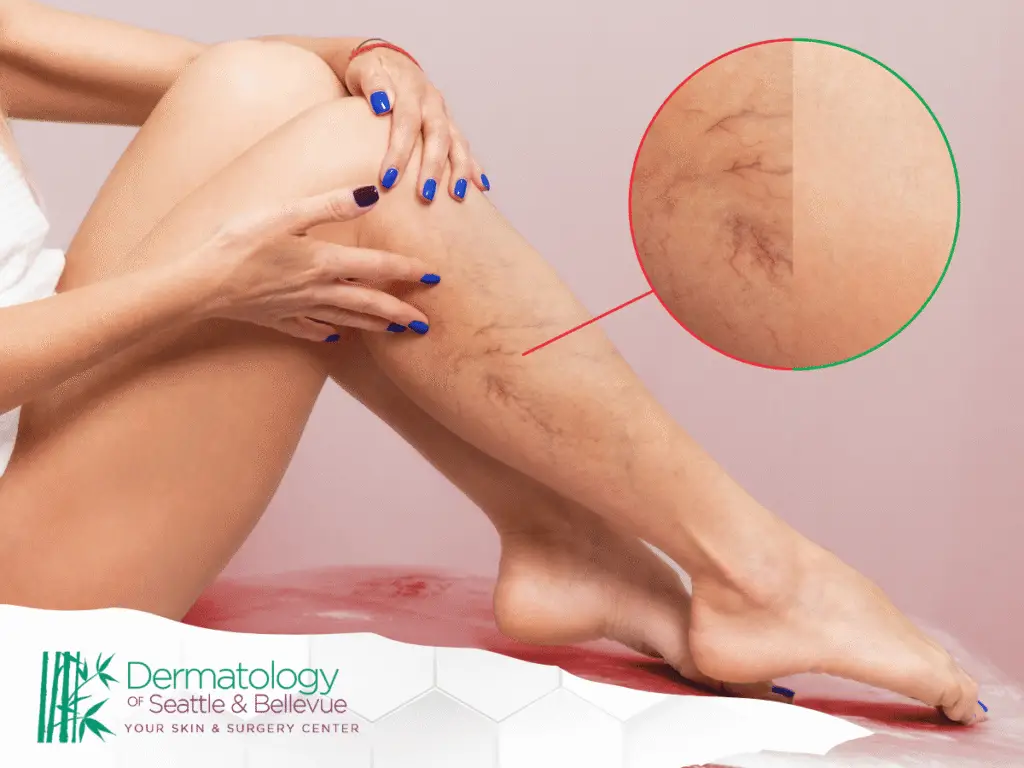 Close-up of woman’s legs showing spider veins and treatment comparison inset.