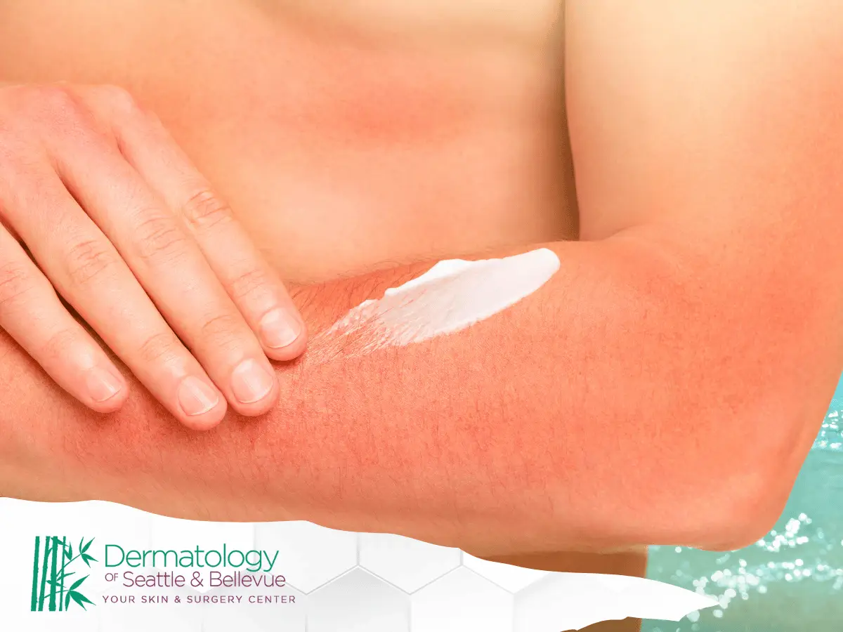 Person applying white cream to red sunburned forearm skin.