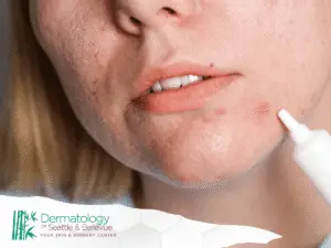 Close-up of person applying acne cream to blemish on chin.