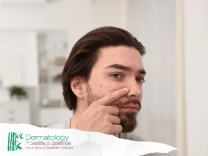 Man with facial acne touching his nose in a bright room