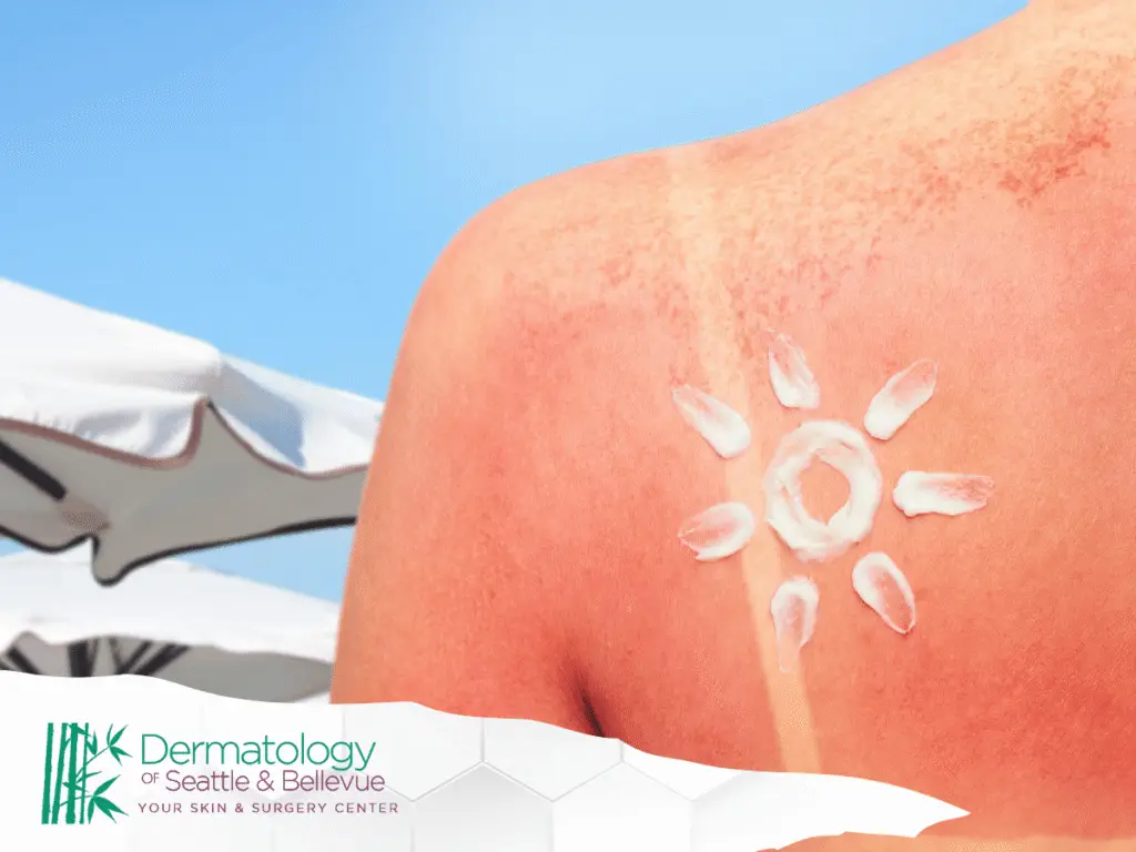 Sunburned back with sunscreen drawn as a white sun.