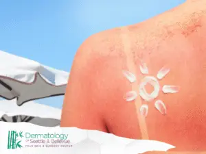 Sunburned back with sunscreen drawn as a white sun.