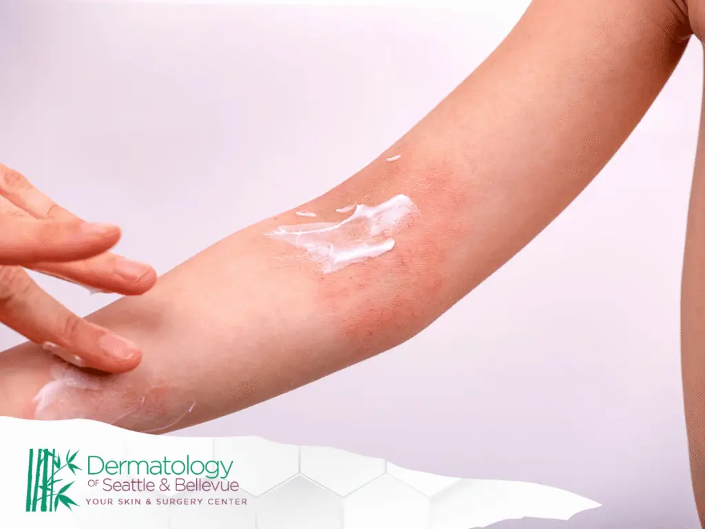 Applying cream to eczema flare-up on arm to demonstrate treatment effectiveness.